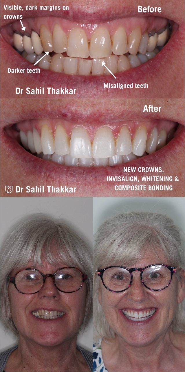 Invisalign before and after