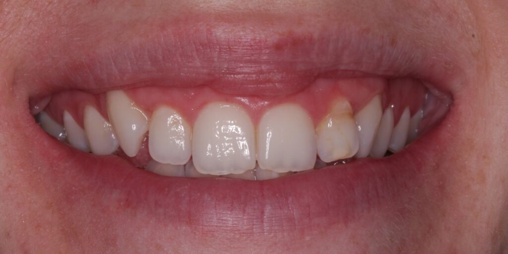 Before