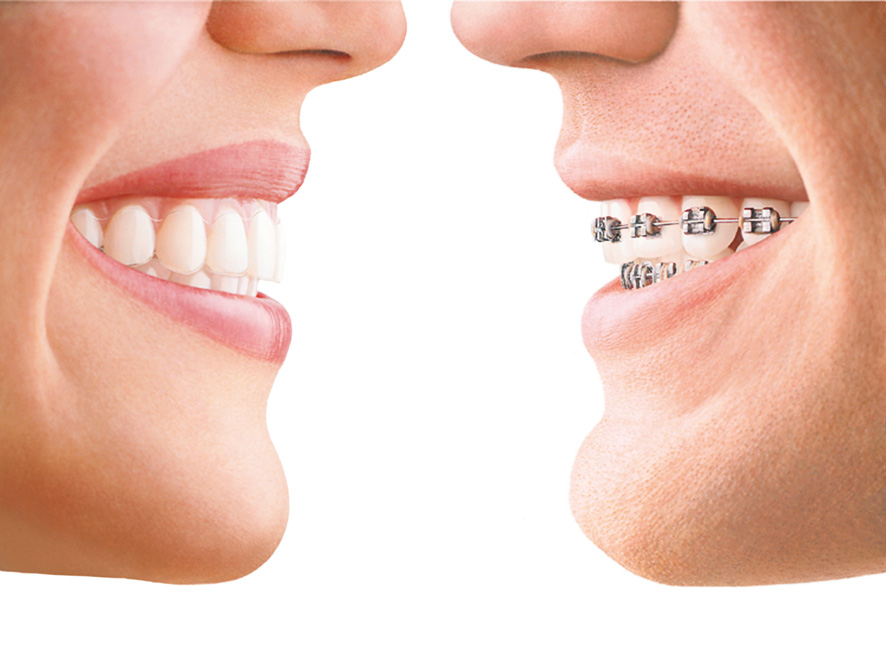 invisalign vs fixed braces